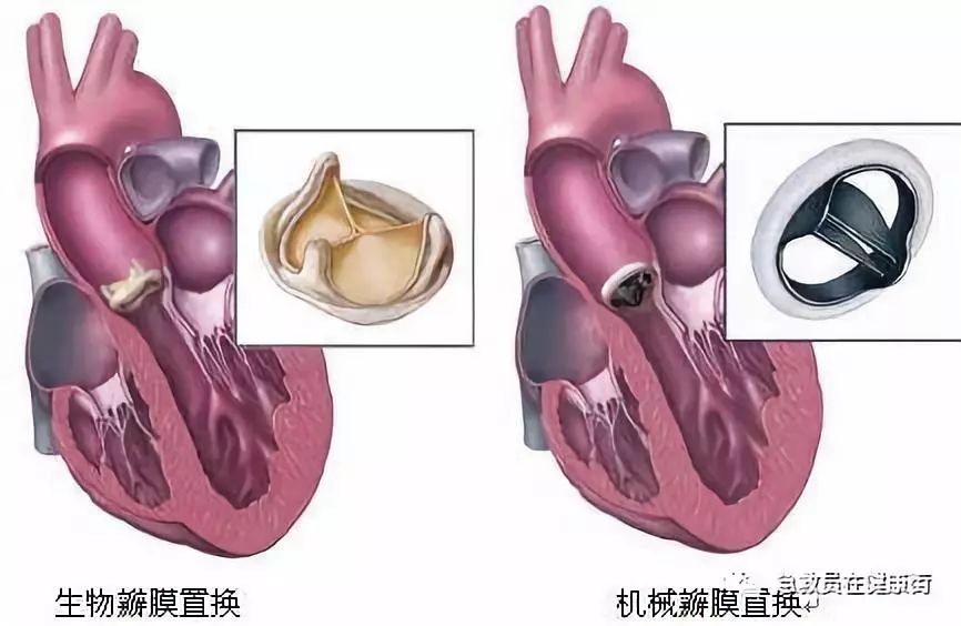 心脏瓣膜置换新技术，重塑生命动力之源